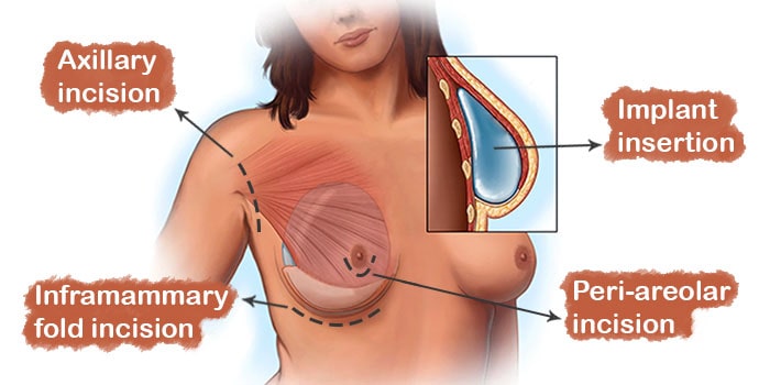 breast implants procedure