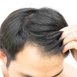 hair loss causes and treatments
