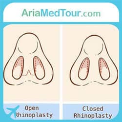 open rhinoplasty surgery