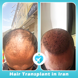 hair transplant in Iran before after