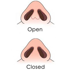 open rhinoplasty vs. closed rhinoplasty