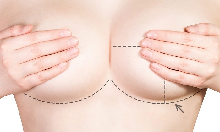 breast reduction scars