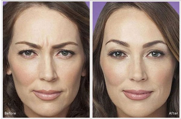 brow lift surgery