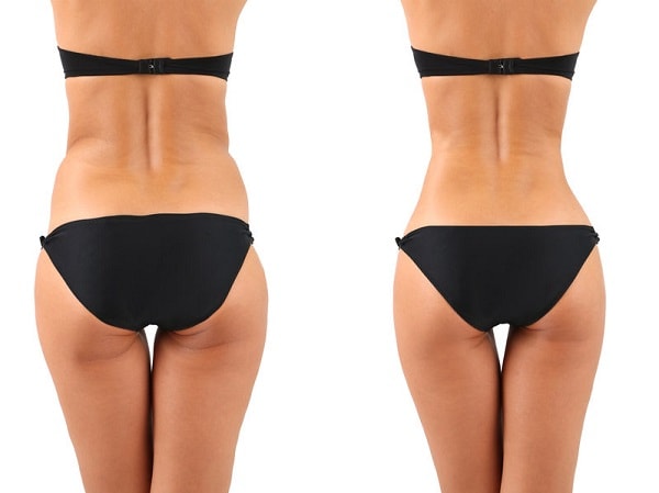 liposculpture and liposuction for women before and after
