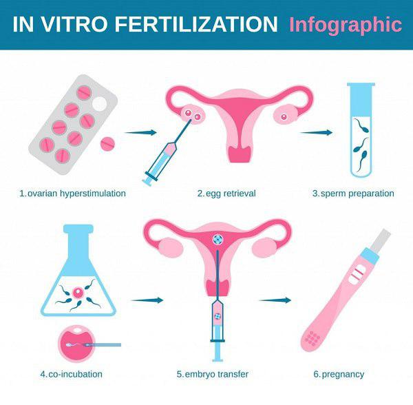 IVM In Iran Effective Affordable In Vitro Maturation