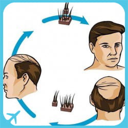FUE hair transplant technique used in hair transplantation surgery in Iran