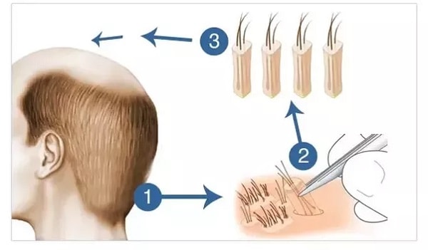 FUE hair transplant method