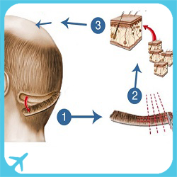 fut hair transplant in Iran