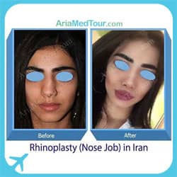 nose job tips