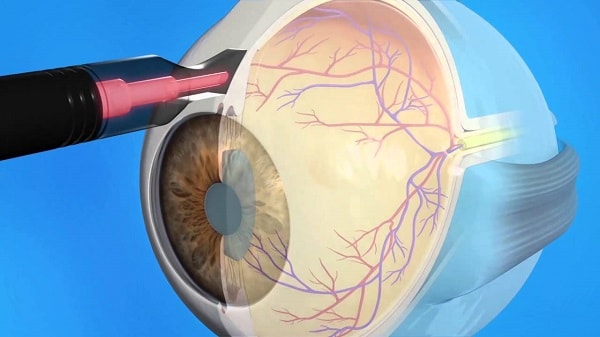 illustration of cyclophotocoagulation as a glaucoma treatment 