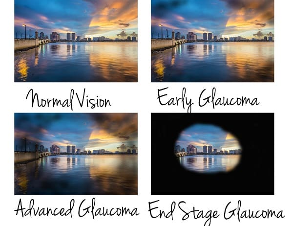 glaucoma symptoms as for vision loss