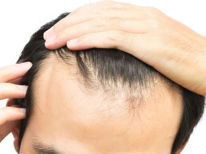 man stroking his hair to see signs of hair loss at hairline area