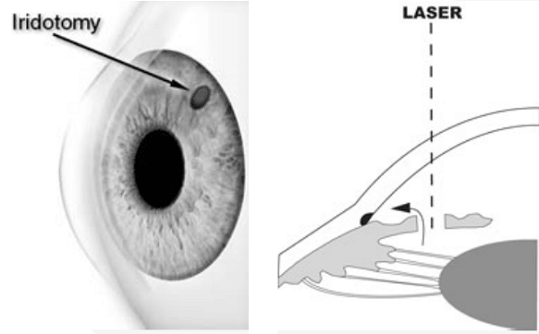 peripheral iridotomy illustration