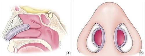 nasal splints