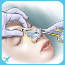 closed rhinoplasty technique