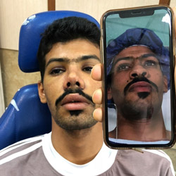 travel to Iran for nose surgery