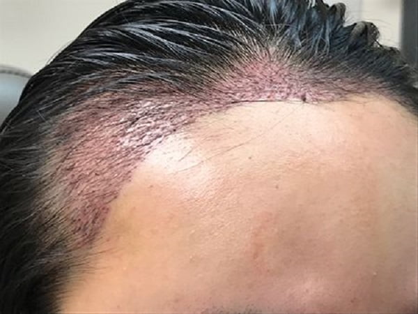 hairline advancement