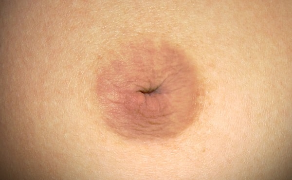 inverted nipple