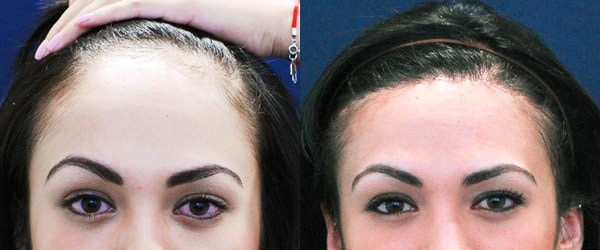 hairline lowering surgery in Iran before and after