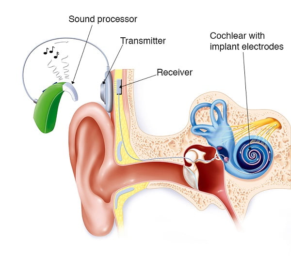 cochlear implant's function