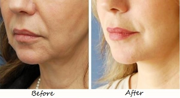 ultherapy before and after