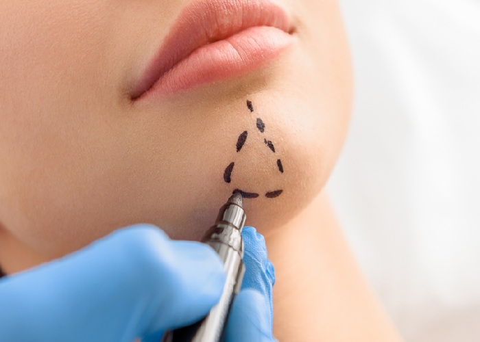 surgeon specifying areas for chin surgery on the patient's face