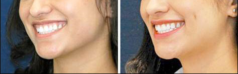 dimple surgery in iran before and after