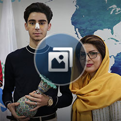 Revision Rhinoplasty Patient in Iran