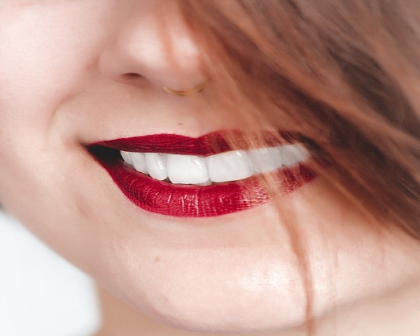 white teeth of a girl after getting dental veneers