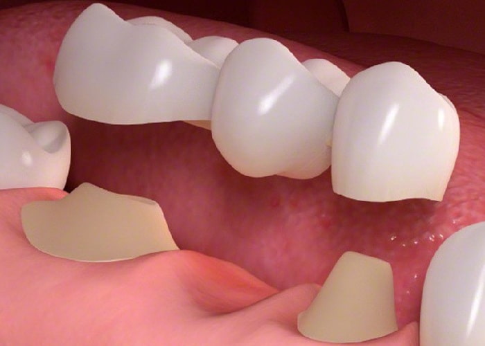 dental bridge prepared to fill in the gap between two teeth