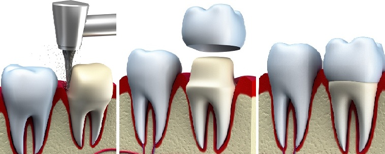 dental crowns procedure in iran step by step