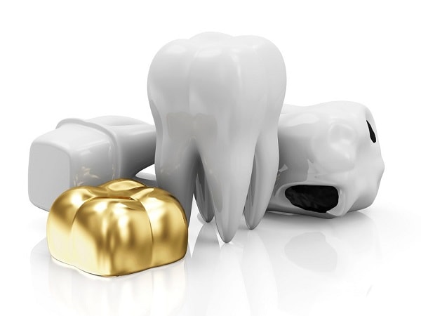 different types of dental crowns made of different materials like gold alloys or porcelain