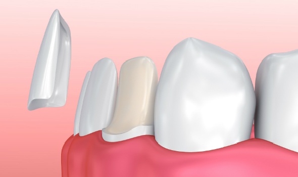 porcelain veneer procedure for a trimmed tooth