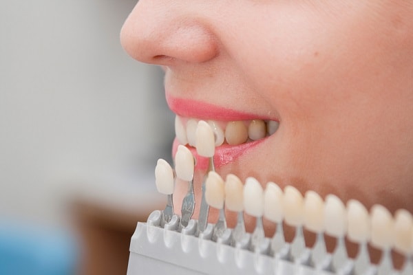 girl smiling as she is getting dental veneers