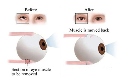 strabismus surgery procedure iran before and after