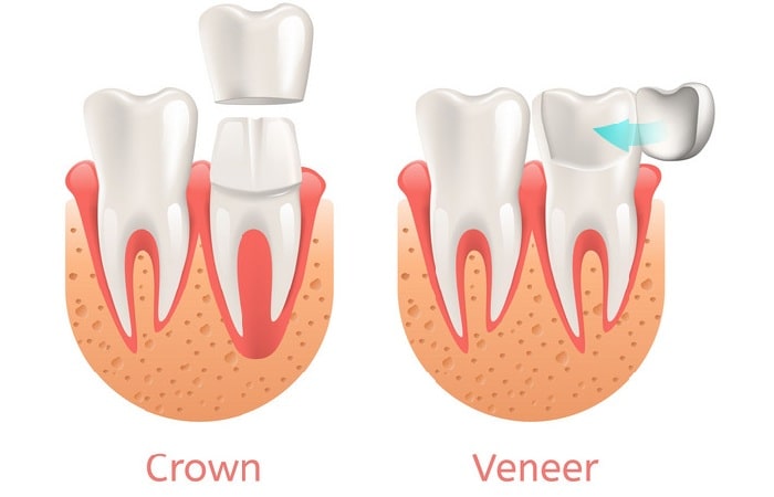 crown vs veneer, the difference between dental veneer and dental crowns