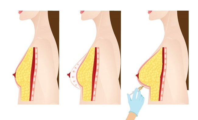 breast augmentation procedure steps using fat transfer in iran