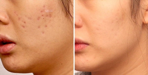 laser treatment in iran before and after photos
