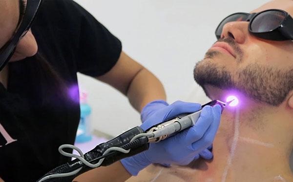 male patient undergoing laser hair removal in iran by iranian doctor