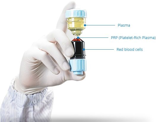 a hand holding a container consisted of PRP taken from the patient's own blood to be used in PRP treatment
