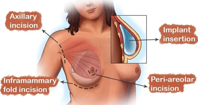 a woman body in which the incisions' places on her breasts and the implants are shown