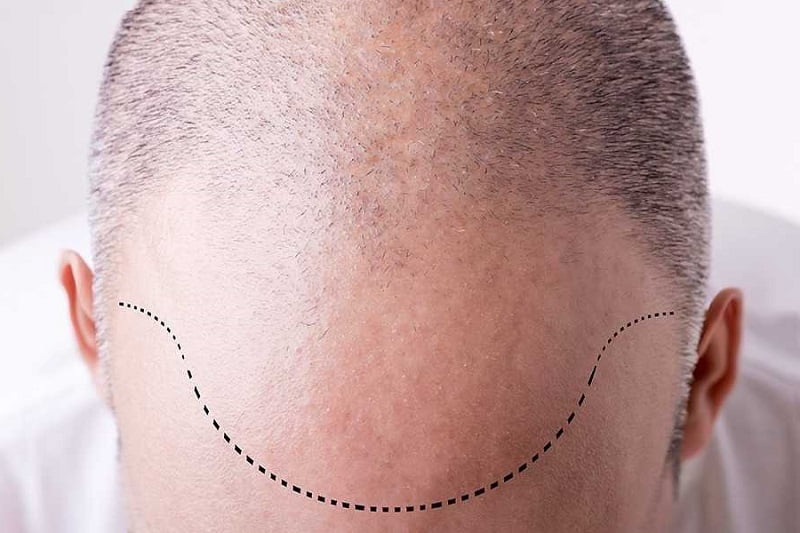 man with dotted line on his forehead showing his to-be hairline after forehead reduction