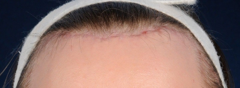 woman with hairline lowering surgery scar