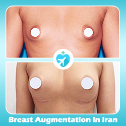 breast augmentation in Iran before after