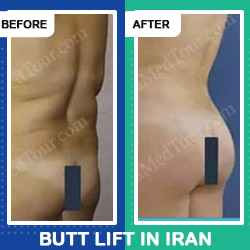 Brazilian butt lift iran before and after