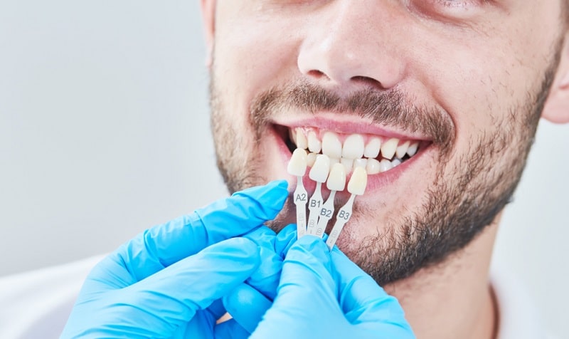 dentist holding a few dental veneers against the smile of a man