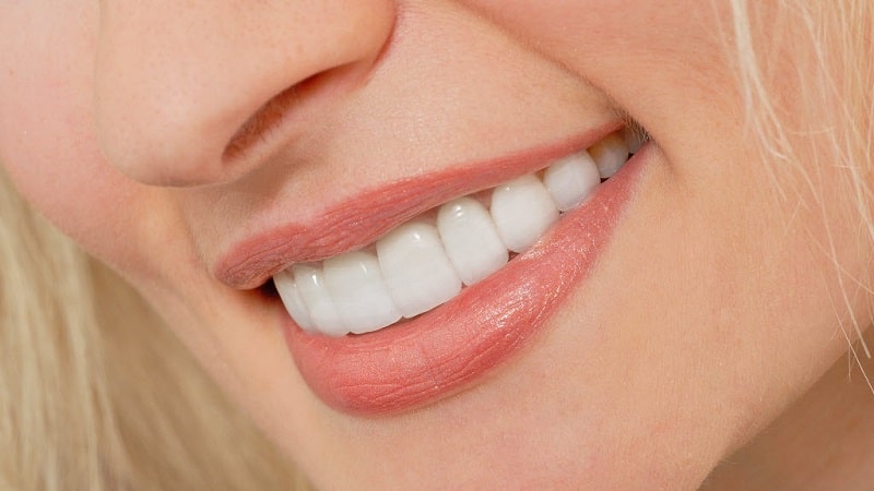 smile of a woman with dental veneers