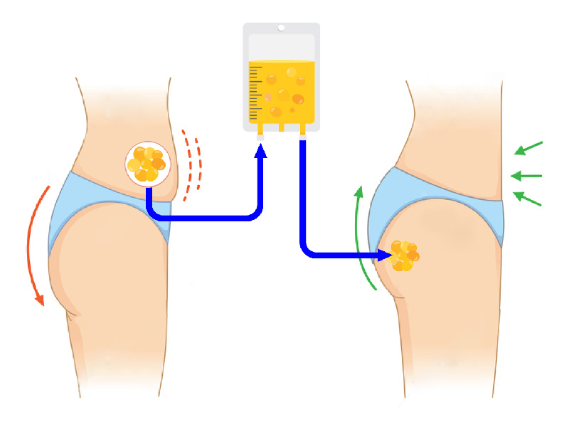 illustration of fat transfer in a Brazilian butt lift procedure