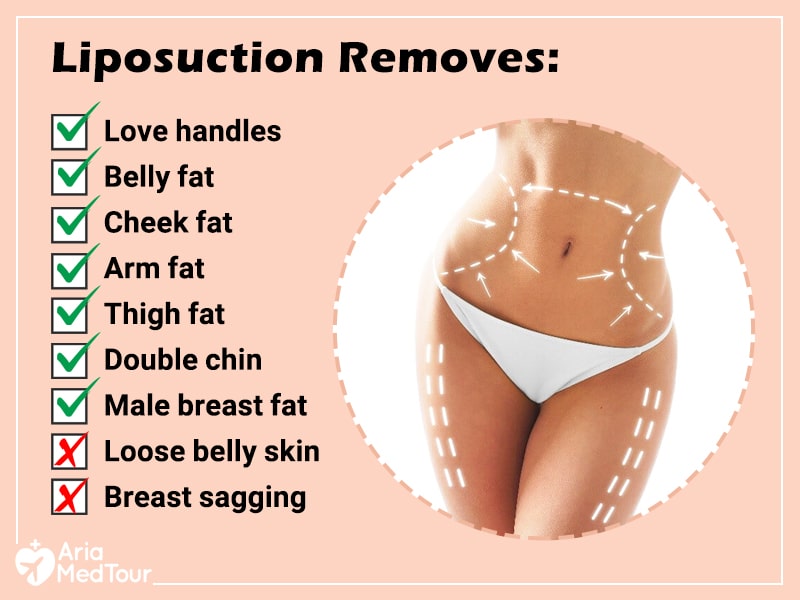 infographic showing what liposuction can and cannot do