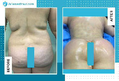 8 Simple Tips for Getting Rid of Swelling After Liposuction